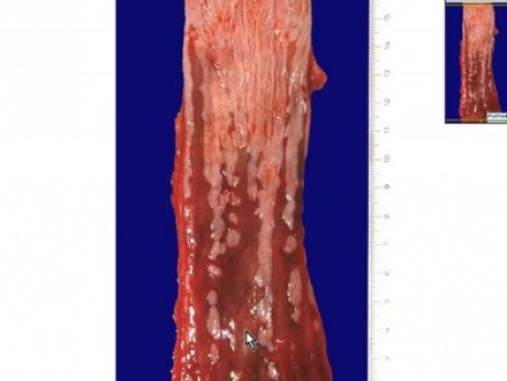 Barrett esophagus 2 - Histopathology - Esophagus