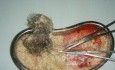 Dermoid Sebacious Material And Hair, 2