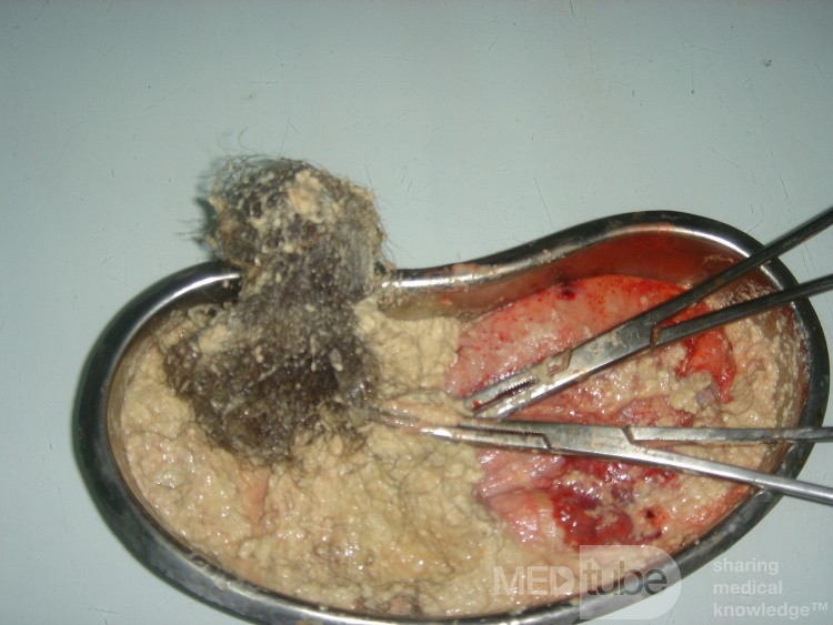 Dermoid Sebacious Material And Hair, 2
