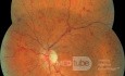 Central Retinal Vein Occlusion