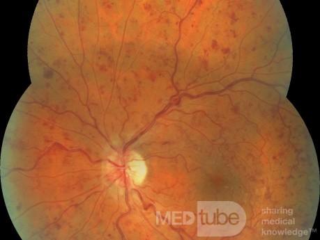 Central Retinal Vein Occlusion