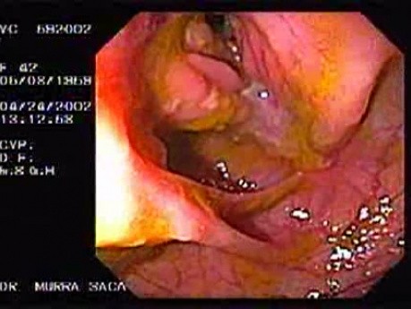Crohn's Disease - Endoscopy (3 of 28)