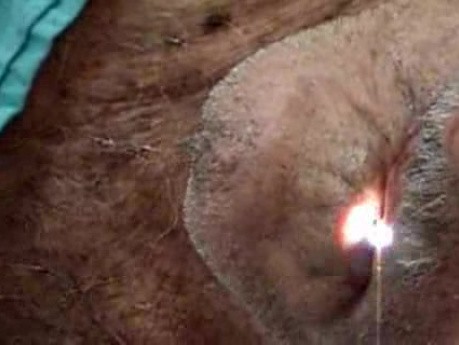 Reterograde Endoscopy - The Endoscope Exits Through The Mouth