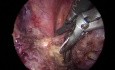 Right TriPort VATS Thoracic Schwannoma Removal