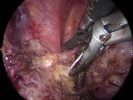 Right TriPort VATS Thoracic Schwannoma Removal