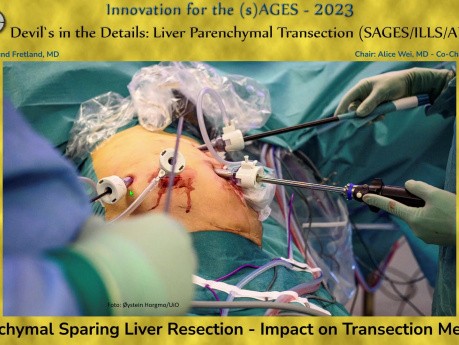 Parenchymal Sparing Liver Resection - Impact on Transection Methods
