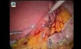 Laparoscopic Sleeve Gastrectomy in 10 steps - Part 2