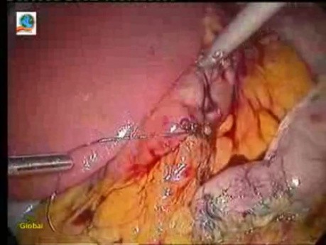 Laparoscopic Sleeve Gastrectomy in 10 steps - Part 2
