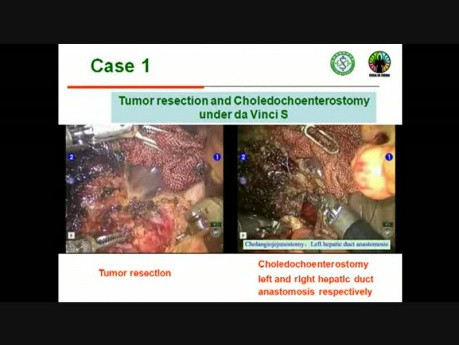 Hilar Cholangiocarcinoma Treatment With Surgical Robot