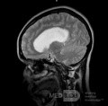 Endoscopic Third Ventriculostomy in a Benign Case of Aicardi Syndrome with Obstructive Hydrocephalus and Chiari Malformation type 1