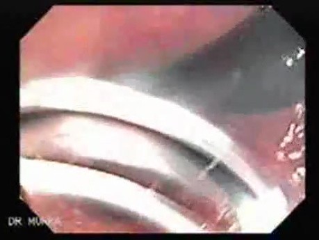 Endoscopic Resection of Giant Tubulo-Villous of the rectum (31 of 35)