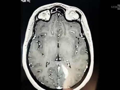 Extended Transnasal Transsphenoidal Transpterygoid Approach for Resection of an Invasive Pituitary Adenoma