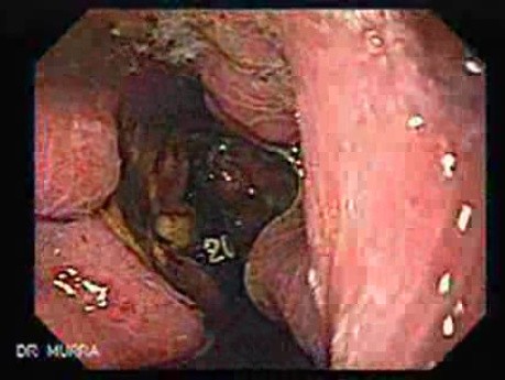 Presence of Multiple Irregular and Large Ulcers - Retroflexed View, Part 2