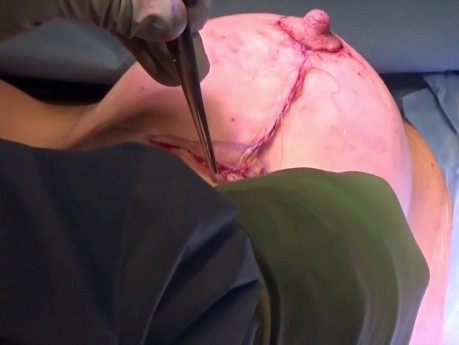 Mastopexy - Peri-areolar Closure 