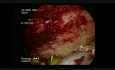  Laparoscopic Drainage of Right Subphrenic Abscess