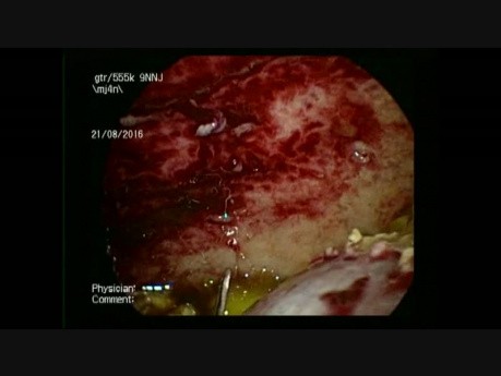  Laparoscopic Drainage of Right Subphrenic Abscess