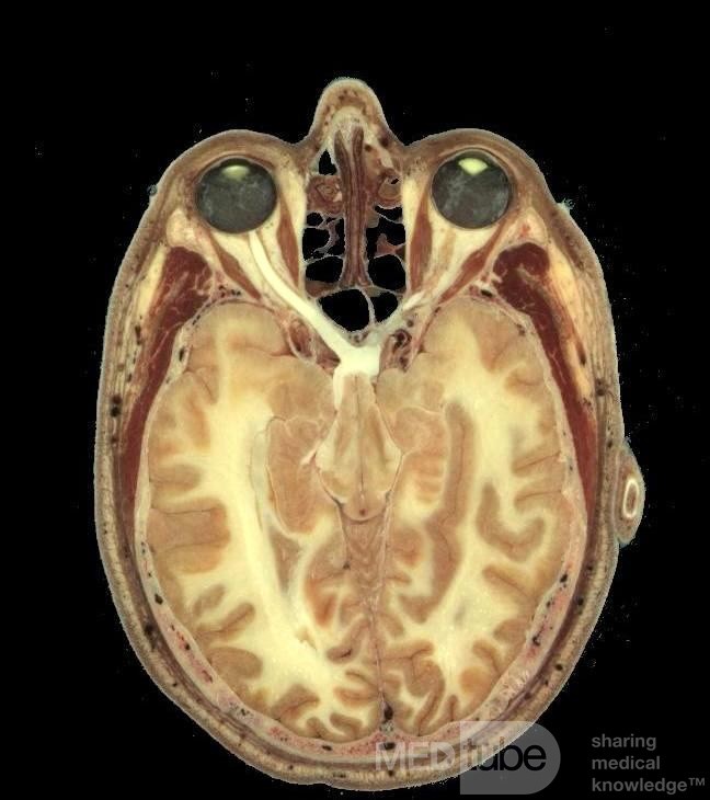 The Relationship between the Sphenoid Sinus and the Optic Nerve