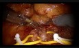 Robot-Assisted Partial Nephrectomy Enhanced with Firefly by Christophe Vaessen