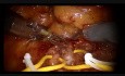 Robot-Assisted Partial Nephrectomy Enhanced with Firefly by Christophe Vaessen