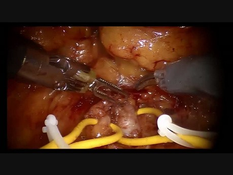 Robot-Assisted Partial Nephrectomy Enhanced with Firefly by Christophe Vaessen