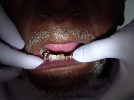 Removable Denture Clasp Repair Part 1