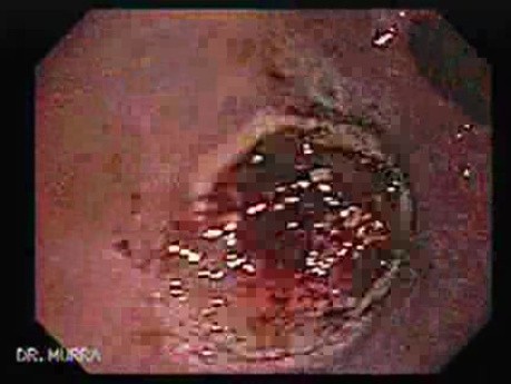 Gastrointestinal Stromal Tumor - GIST (10 of 65)