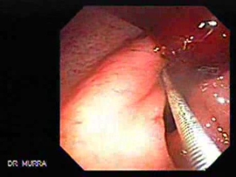 Duodenal Ulcer and Bleeding (3 of 23)