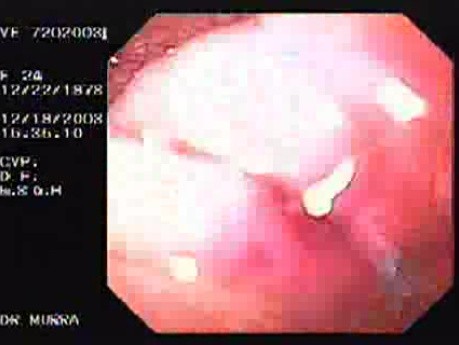Flexible Endoscopic Suturing - Image of 4 Threads After Traction