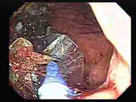 Status After Dilatation with Balloon - Endoscopic Assessment