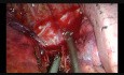 Uniportal VATS Lobectomy for Huge Pulmonary Sequestration with Dangerous Artery from Abdominal Aorta
