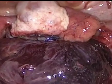 Torsion of Paroarian Cyst
