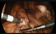 Live Gastric Bypass Surgery - Hand Sewn Gastrojejunostomy