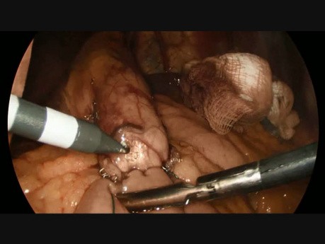 Live Gastric Bypass Surgery - Hand Sewn Gastrojejunostomy