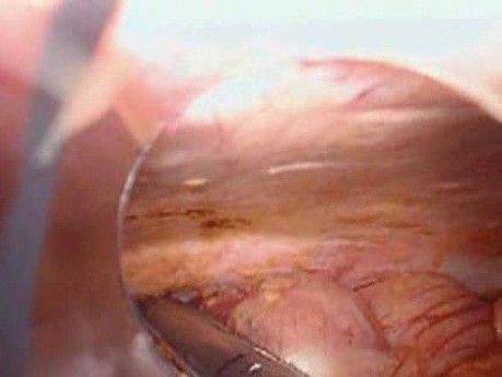 Colonic Perforation With Peritonitis - Laparoscopy (7 of 46)