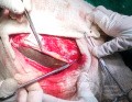 Acute Spontaneous Subdural Hemorrhage in the Subdural Space