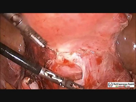 Laparoscopic Hysterectomy By Ligation of Uterine Artery and Simultaneous Appendectomy