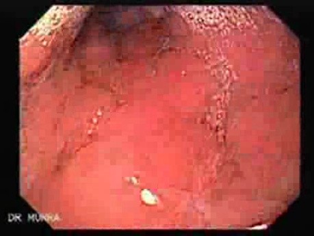 Scirrhous Gastric Carcinoma - Endoscopy (1 of 47)