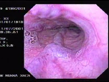 Upper Gastrointestinal Hemorrhage -  Endoscopic Image of Esophageal Varices