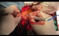 How to Perform MVR LAA Closure and AF ablation and Pulmonary Veins Isolation and Aortopulmonary AF Ablation Technique