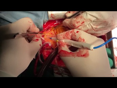 How to Perform MVR LAA Closure and AF ablation and Pulmonary Veins Isolation and Aortopulmonary AF Ablation Technique