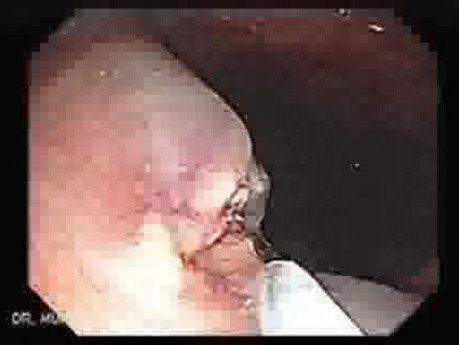 Huge Mass Of The Descending Colon (20 of 25)