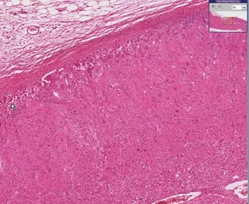 Amyloidosis At Adrenal Gland
