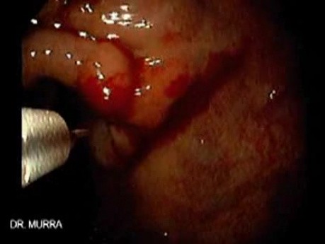 Gastric Varices (10 of 25)