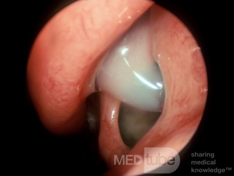 Accessory Maxillary Sinus Ostium with the Recirculating Mucus