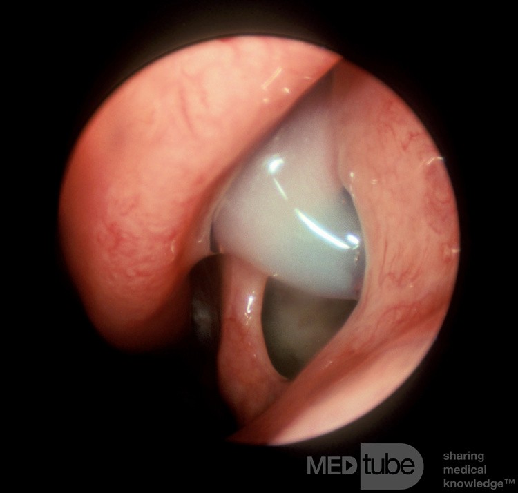 Accessory Maxillary Sinus Ostium with the Recirculating Mucus
