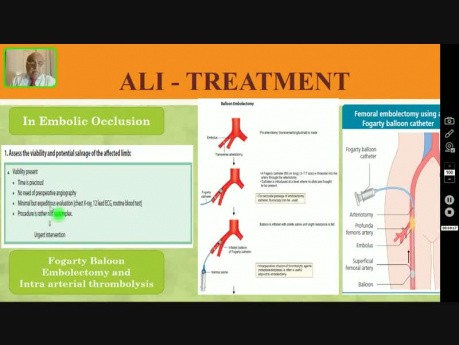 Acute Lower Limb Ischemia - Peripheral Arterial Diseases