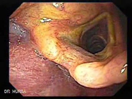 Larynx with Jaundice (1 of 6)