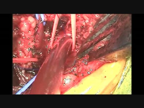 Cannulating the Axillary Artery