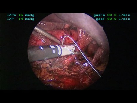 Laparoscopic Parahiatal Hernia Repair With Mesh