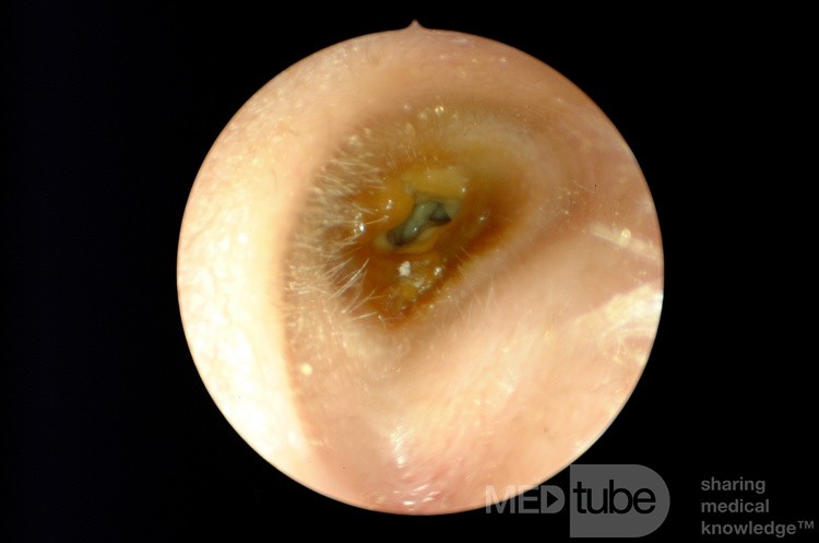 Chronic Mixed Pathogen Otitis Externa